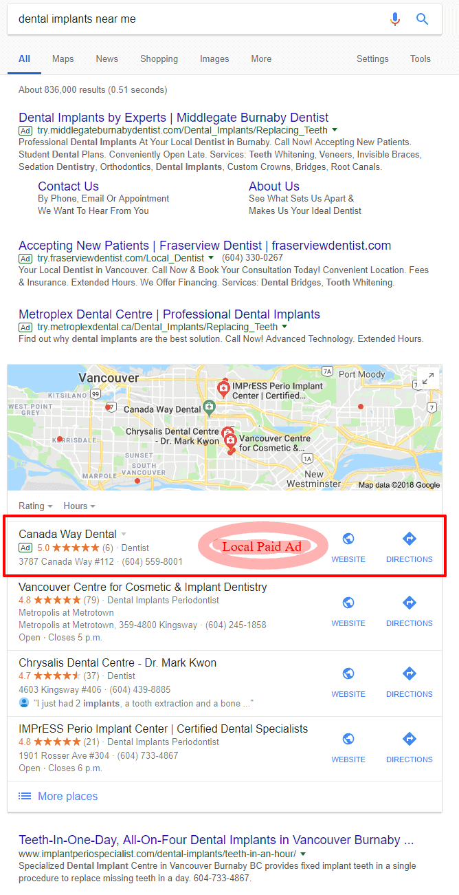 Google Search Results for dental implants near me